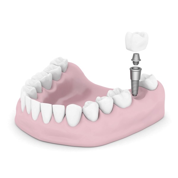 Dental Implants Vs Dental Bridges
